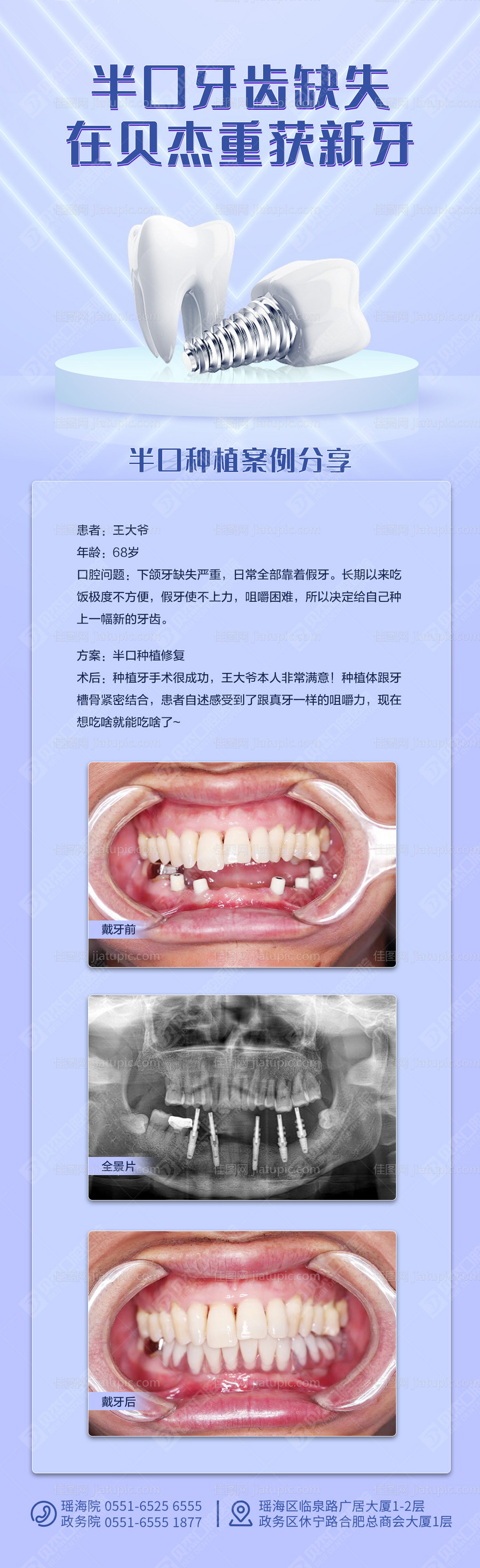 半口缺失案例-源文件